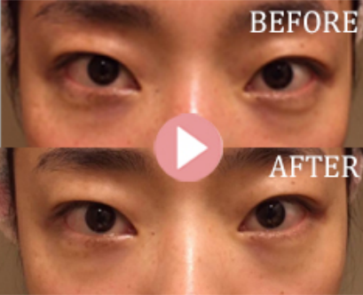 不是所有的黑眼圈都能通过“早睡”解决