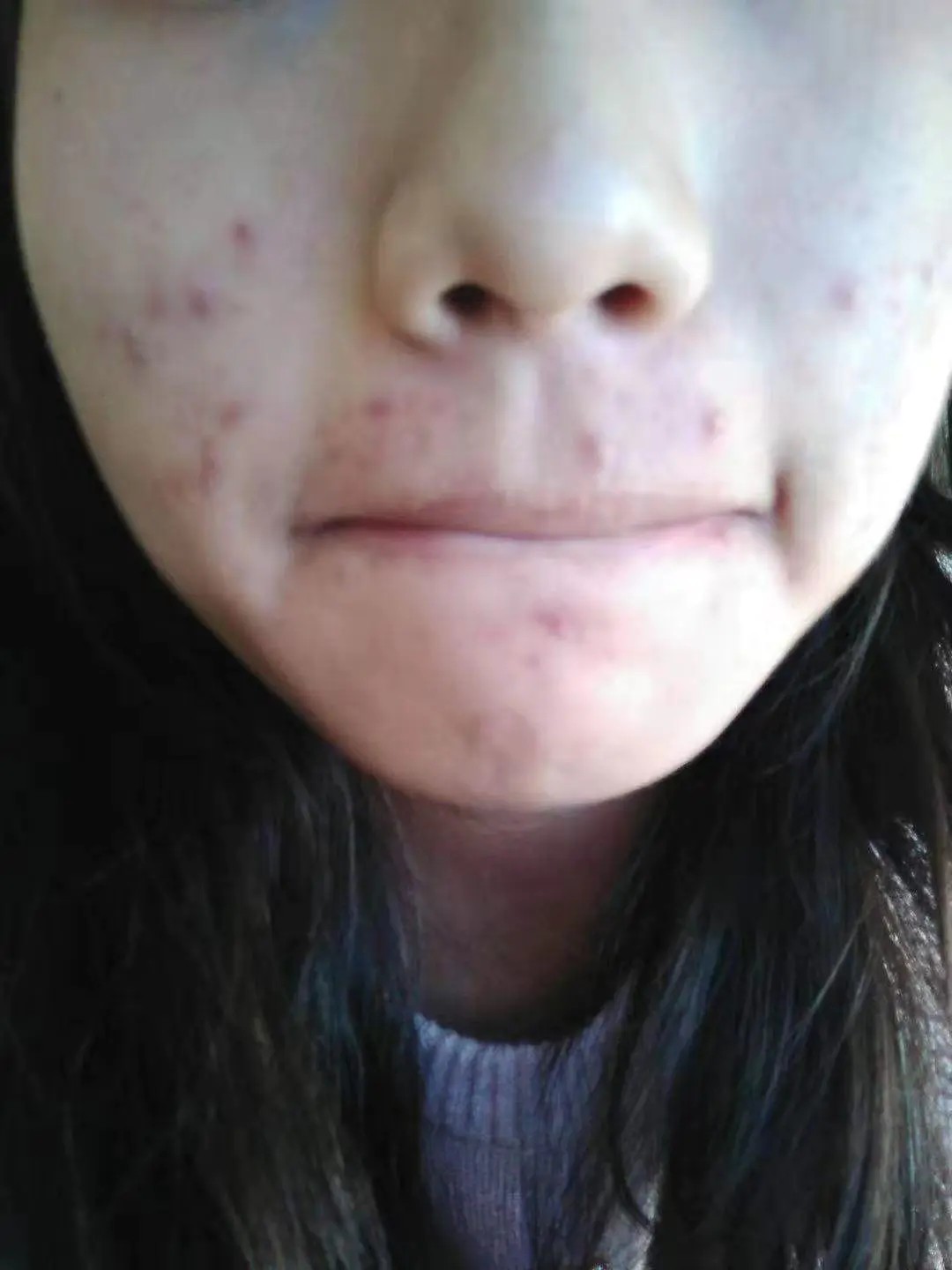 怎么去除痘痘？芦姬的祛痘霜效果怎么样？这些小知识你需要知道！