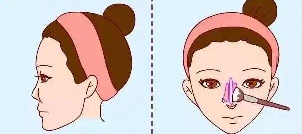 谭晓燕医师：隆鼻修复的费用有哪些