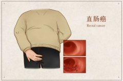 直肠超低位恶性肿瘤能否保肛成功?省中医院多学科协同再次刷新记录
